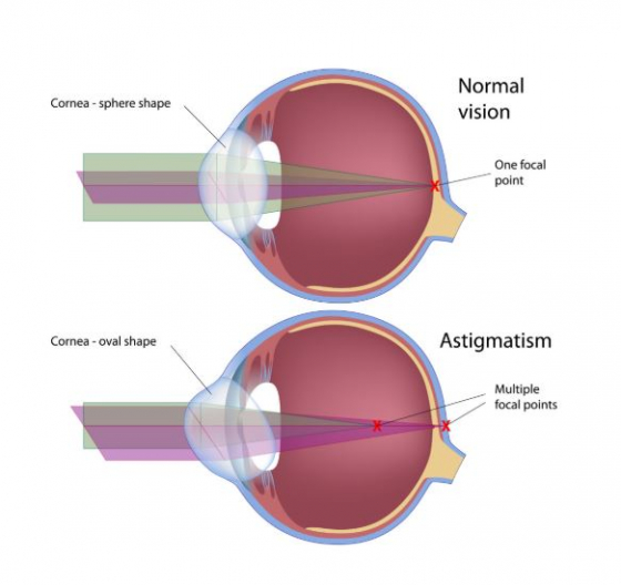 lentile progresive pentru miopie