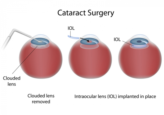 prognostic pentru vederea cataractei