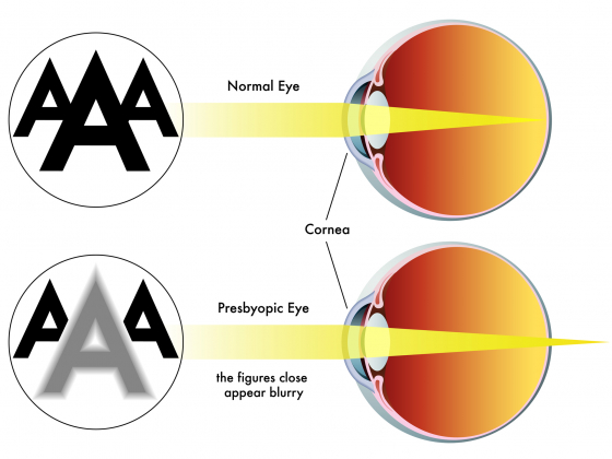 Cum pot sa corectez vederea unui ochi cu mult diferit de celalalt?